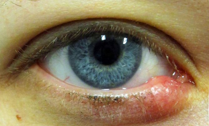 خصائص الصبار الطبية وصفات العين