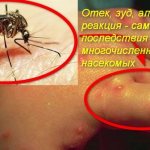 следи от комари и ухапвания по ръката