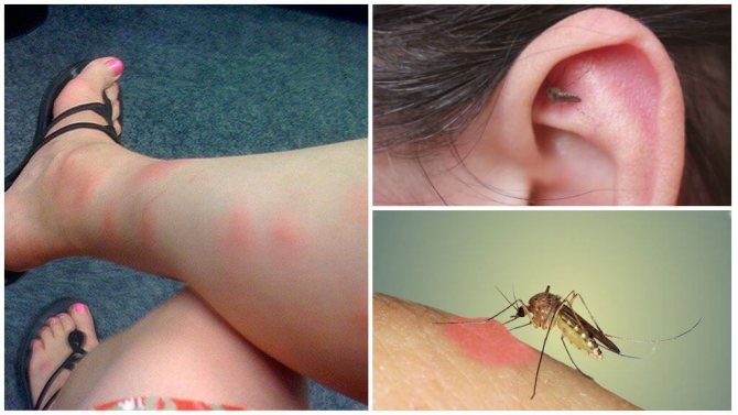 последиците от ухапване от комар